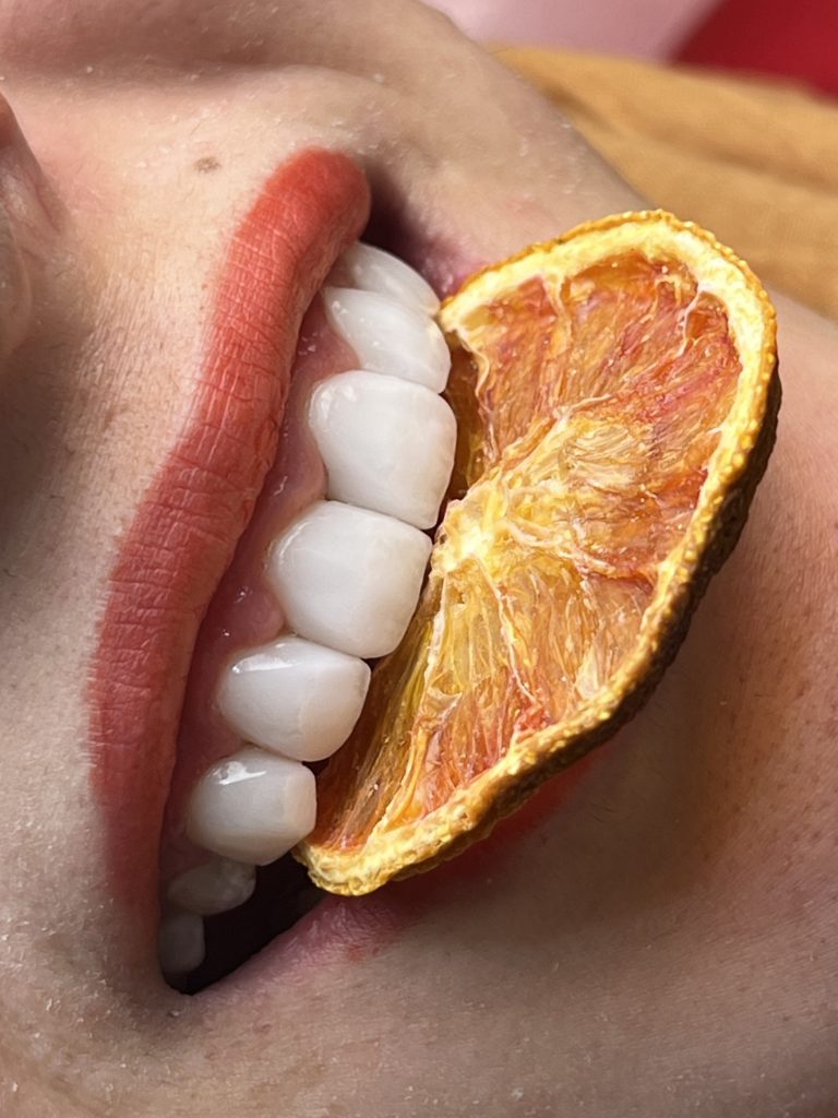 لمینت توسط دکتر مرضیه سالاری